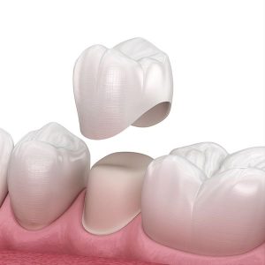 Dental Crowns in Turkey