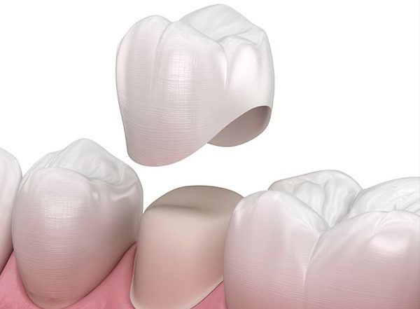 Dental Crowns in Turkey