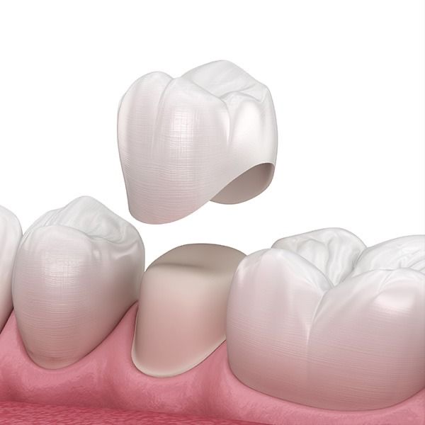 Dental Crowns in Turkey