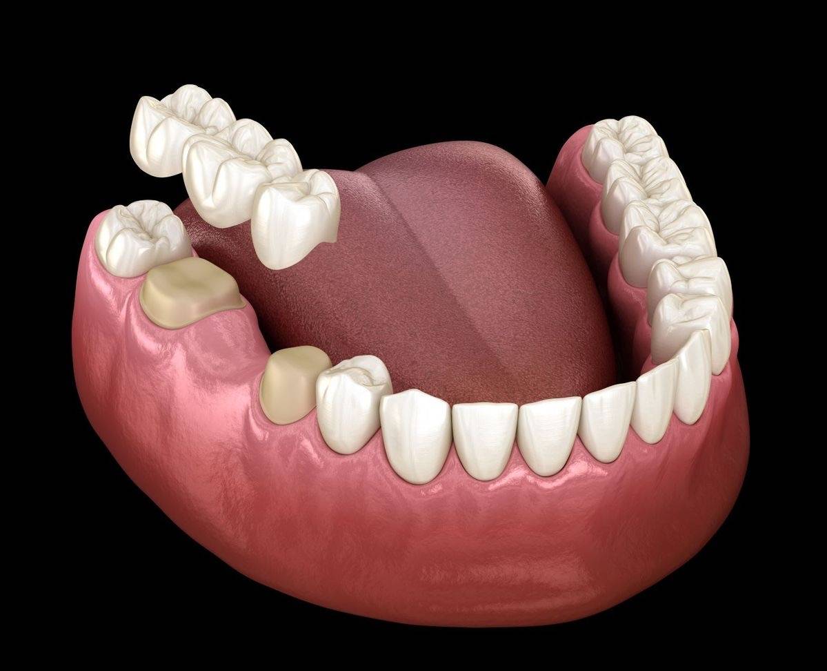 Dental Bridge in Turkey