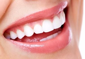 Porcelain Veneers in Turkey