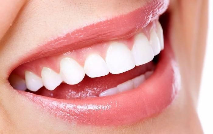 Porcelain Veneers in Turkey