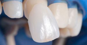 Laminate Veneers in Turkey