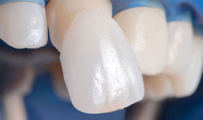 Laminate Veneers in Turkey