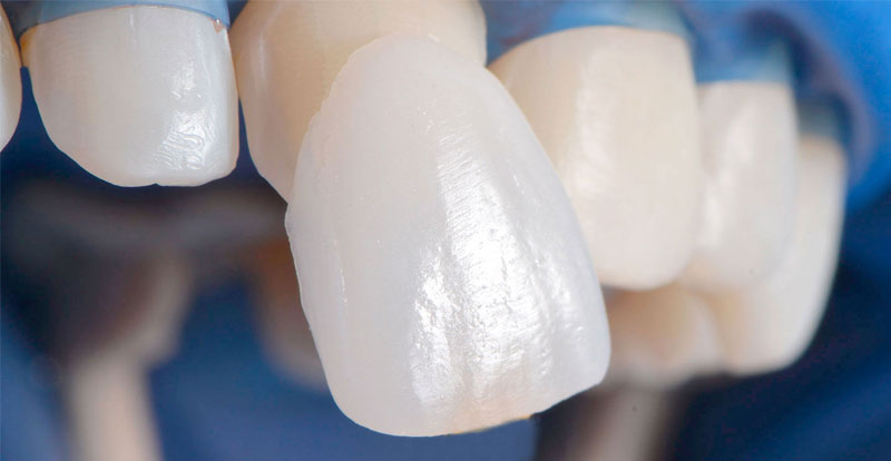 Laminate Veneers in Turkey