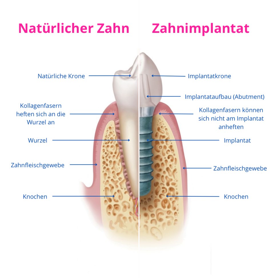 Schema des Implantataufbaus im Vergleich zum natürlichen Zahn