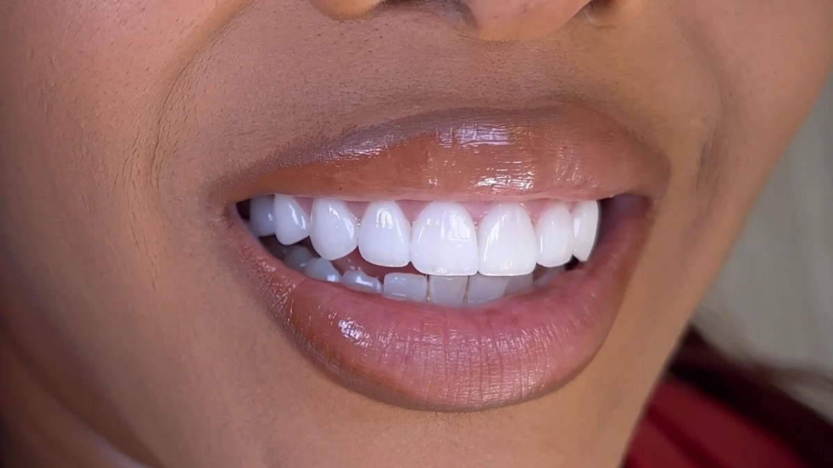 Smile Makeover Using Crowns and Veneers Turkey