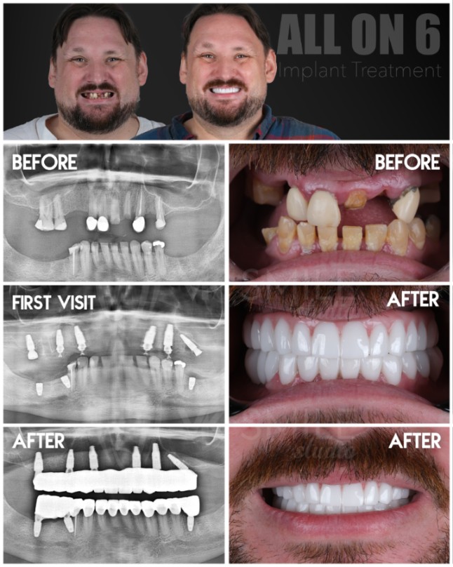 All-on-6 dental implants in Turkey