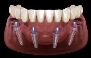 all on 4 Dental Implant