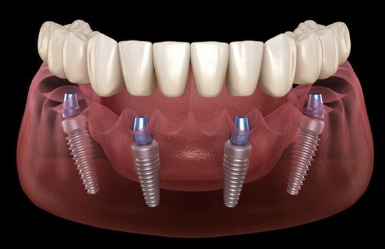 all on 4 Dental Implant