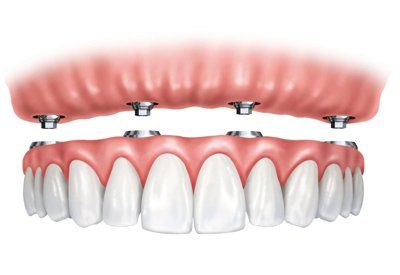 all on 4 Dental Implants procedure