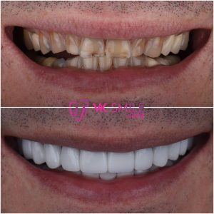 All on 4 before after