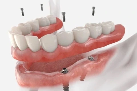 All-on-4 Dental Implants