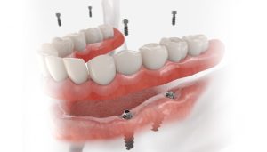 all on 4 dental implants turkey