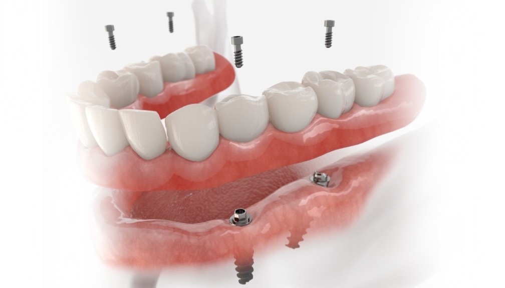 all on 4 dental implants turkey
