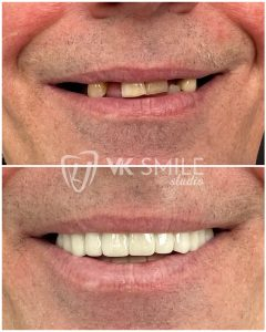 All on 4 before after