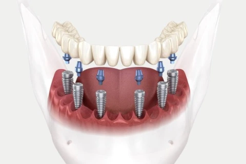 All-on-6 Dental Implants