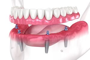 are-full-mouth-dental-implants-worth-it-in-turkey