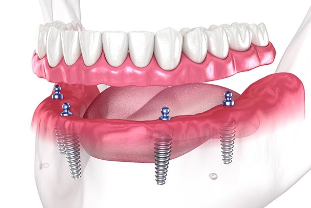 are-full-mouth-dental-implants-worth-it-in-turkey