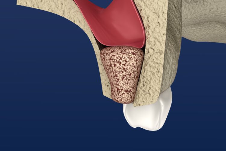 Autogenous Bone Graft