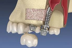 Autogenous Bone Graft