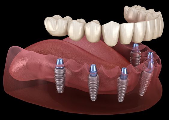 All on 6 dental implants