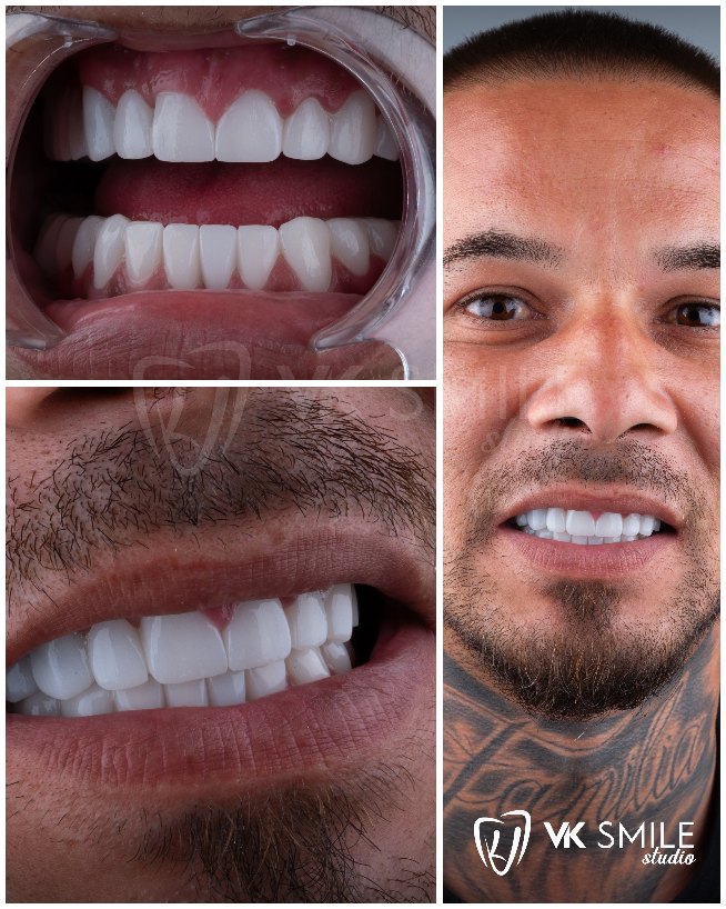 before after 10