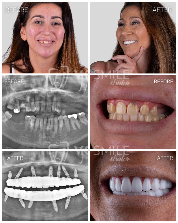 Full mouth dental implants in Turkey