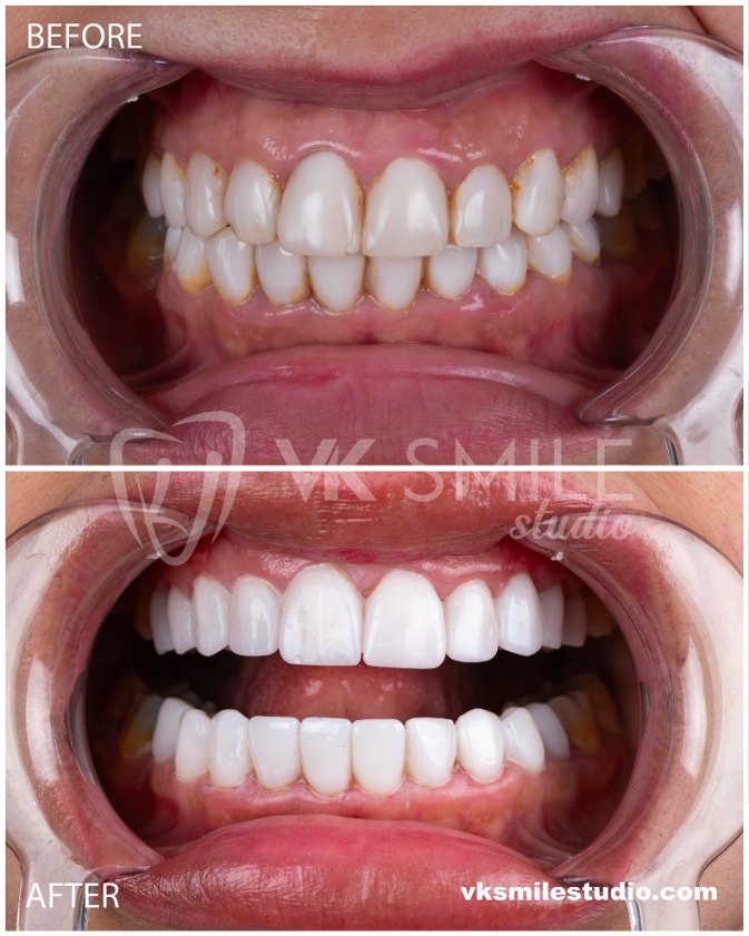 VK Smile Studio before after