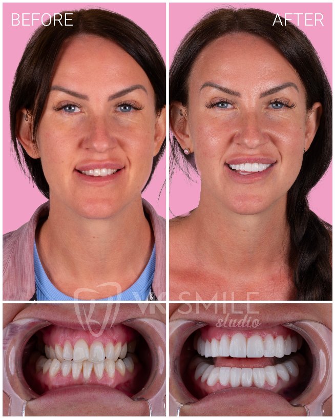 VK Smile Studio before after