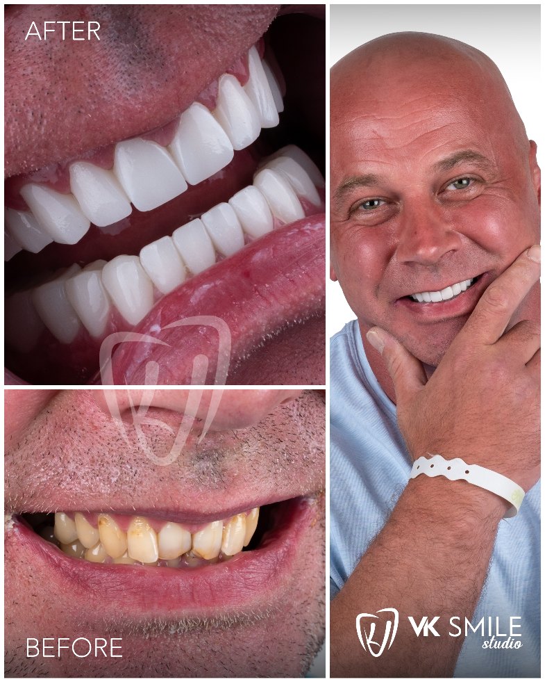 Porcelain veneers in Turkey