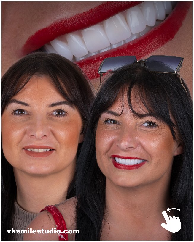 Porcelain veneers in Turkey