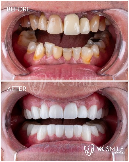 VK Smile Studio before after