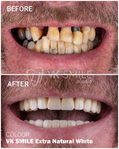 VK Smile Studio before after