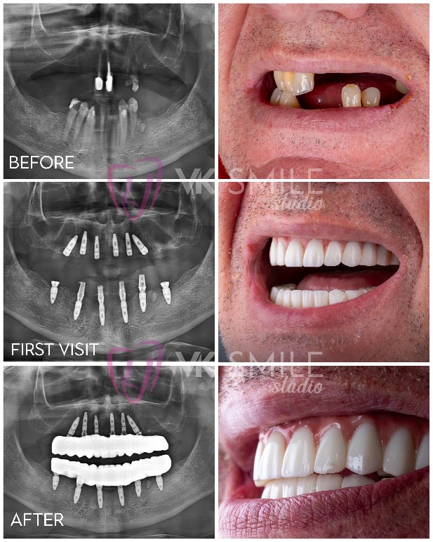 Full mouth dental implants in Turkey