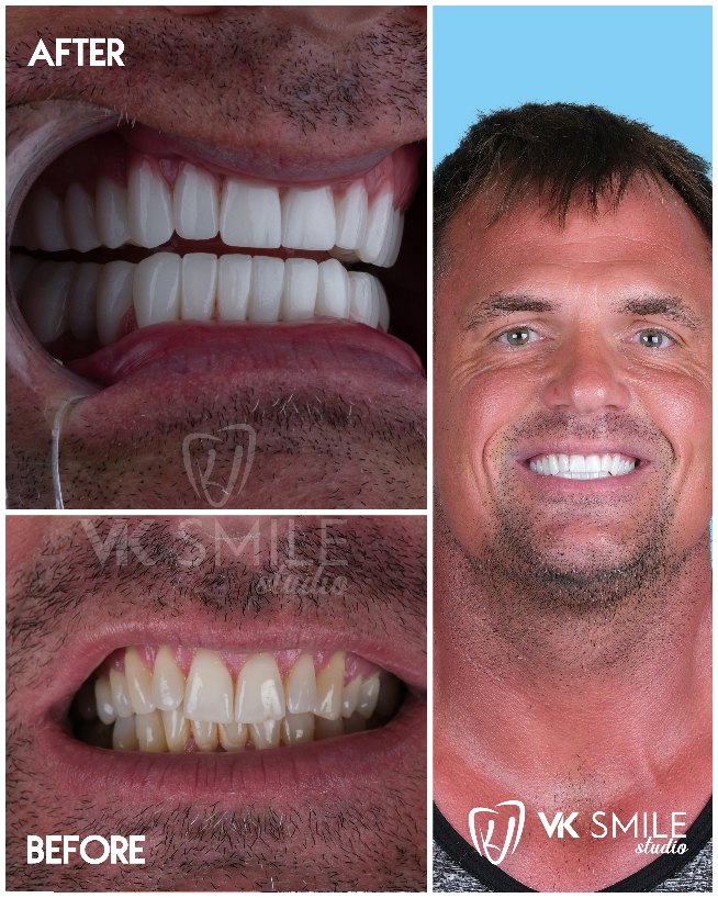 before after 37