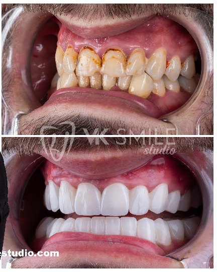 VK Smile Studio before after