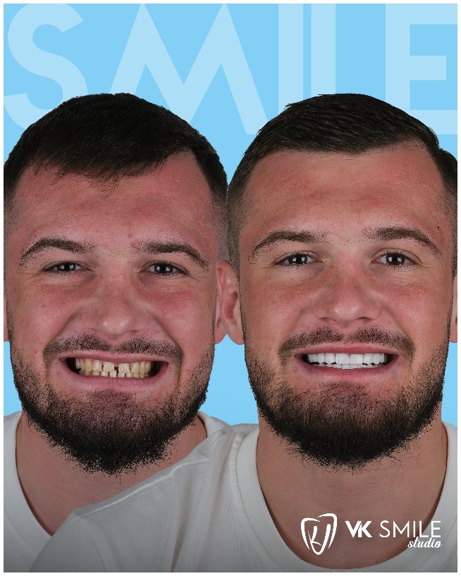 Hollywood smile Turkey