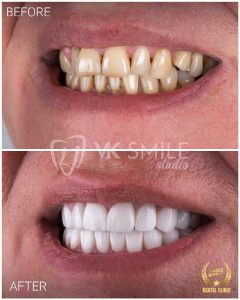 VK Smile Studio before after
