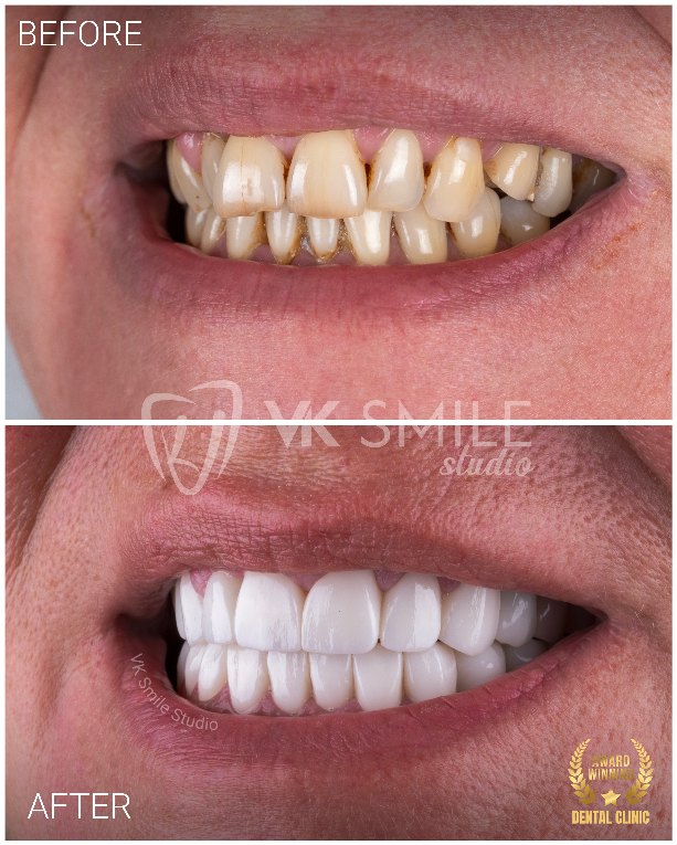 VK Smile Studio before after