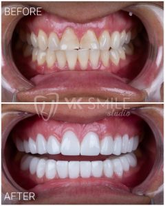 VK Smile Studio before after