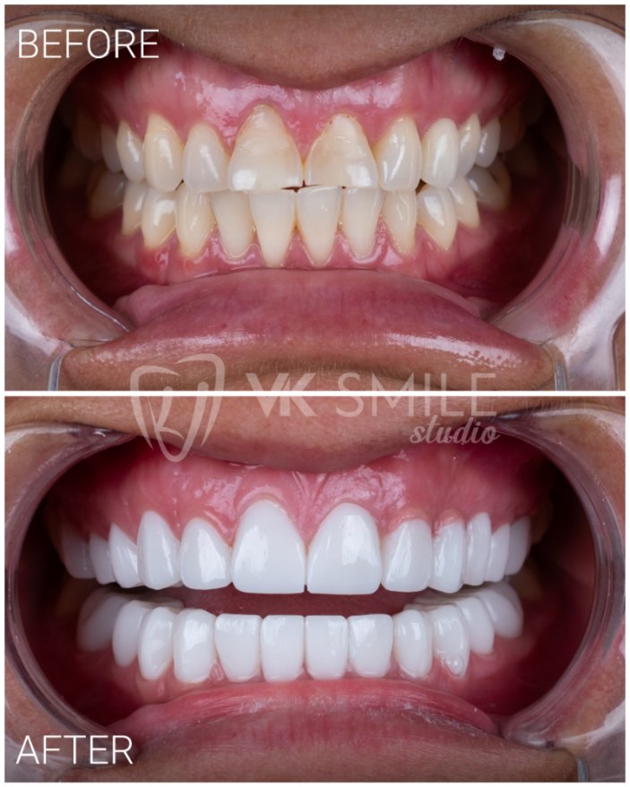 VK Smile Studio before after