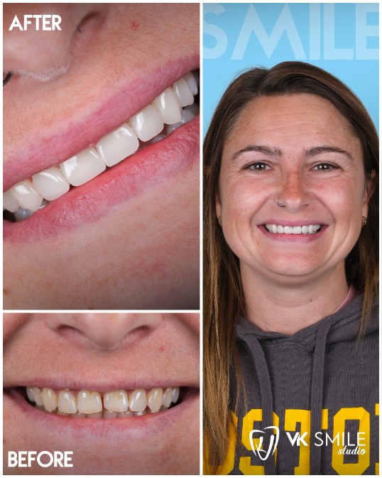 Dental veneers Turkey