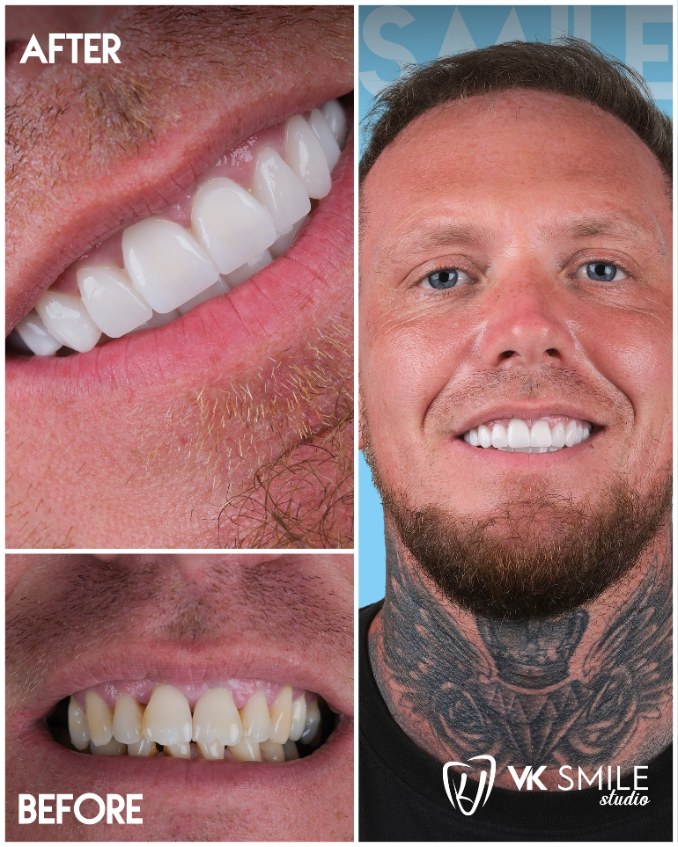 Dental crowns Turkey