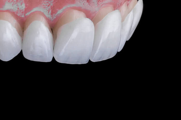 Best Place to Get Veneers Done in Turkey