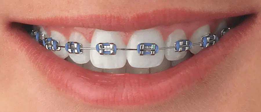 Braces