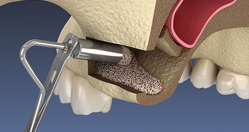 Closed Sinus Lifting