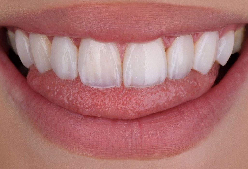 Composite bonding in Turkey