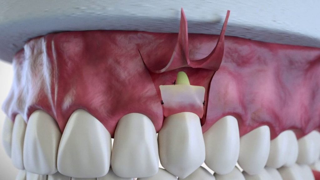 Connective Tissue Transplantation