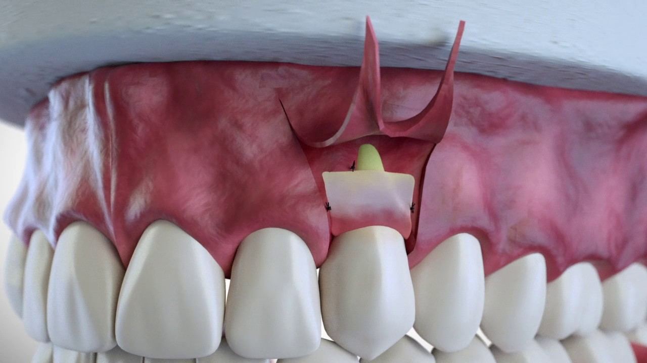 Connective Tissue Transplantation